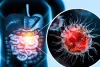 40 से कम उम्र के लोगों में; यह 5 कारणों से बढ़ रहा है कोलोन कैंसर का रिस्क